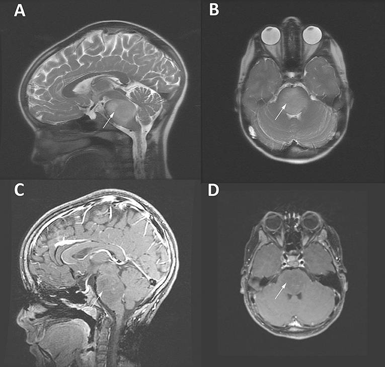 Pediatric_diffuse_intrinsic_pontine_glioma